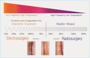 Σύγκριση Electrosurgery - Radiosurgery